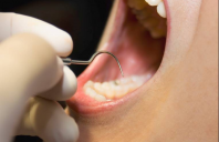 Debate Over Silver Amalgam Tooth Fillings Shifts to the Environment